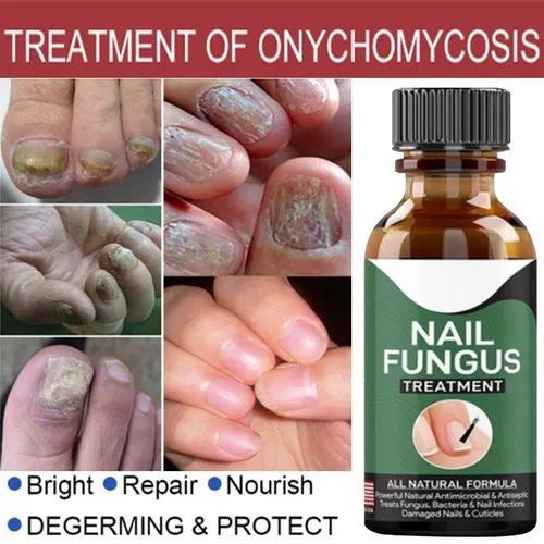 Fast Nail Fungal Treatments
